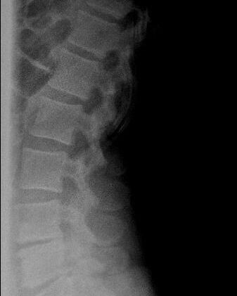spine