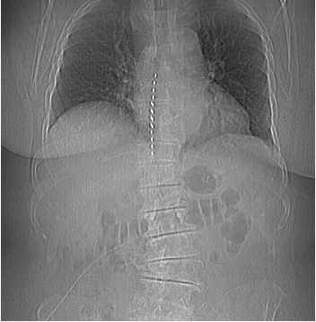 mri