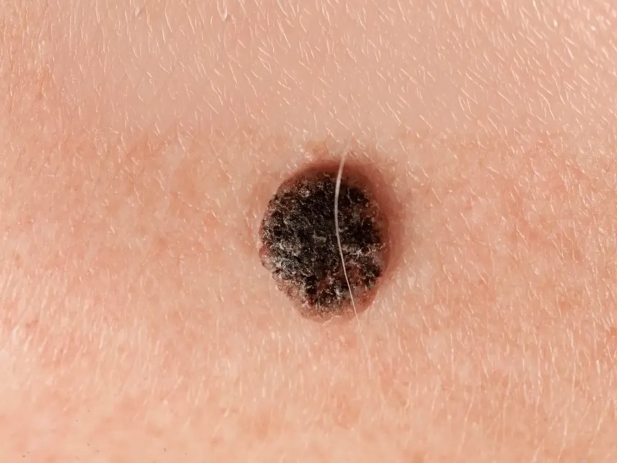 carcinoma 